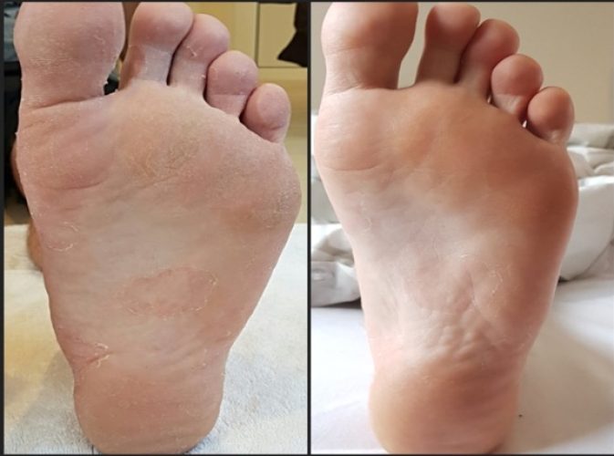 Before after feet with FND GOLD